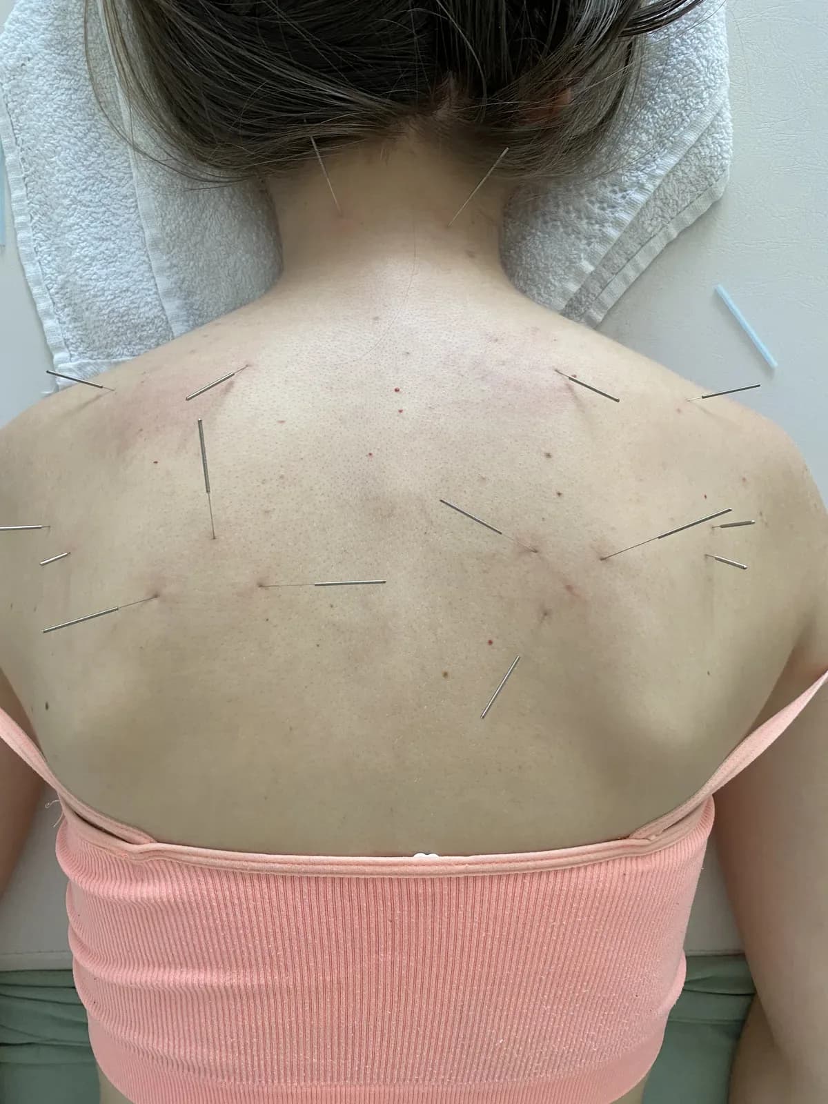 Dry needling u Fiziosensu — tanke iglice postavljene na okidačke tačke gornjeg dela leđa (Leskovac)